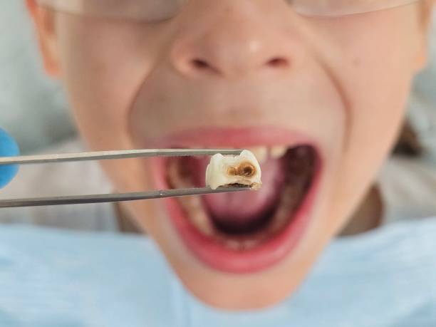 Best Emergency Dental Extractions in Saticoy, CA